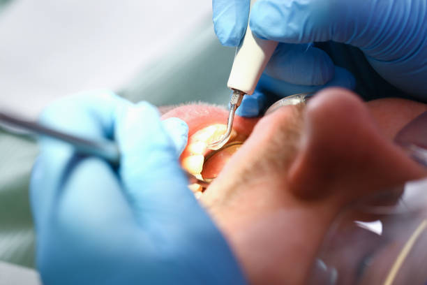 Best Dentist for Tooth Abscess  in St Robert, MO